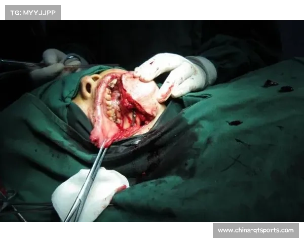 独立格斗选手史密斯伤势严重,颚骨骨折及多颗牙齿脱落 独立格斗选手史密斯伤势严重,颚骨骨折及多颗牙齿脱落